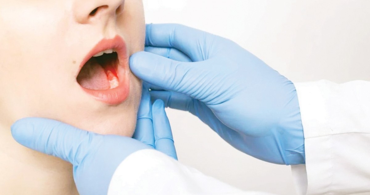 أربع علامات تنذر  بخطر سرطان الفم