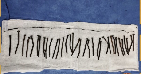 مصرية ابتلعت 34 مسماراً... والمنظار أنقذها #مصر 