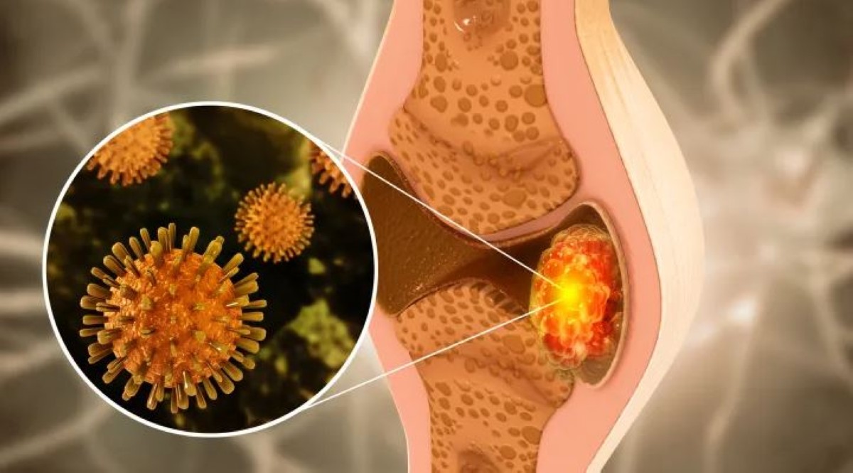 جسيمات مبتكرة قد تحدث ثورة في علاج السرطان