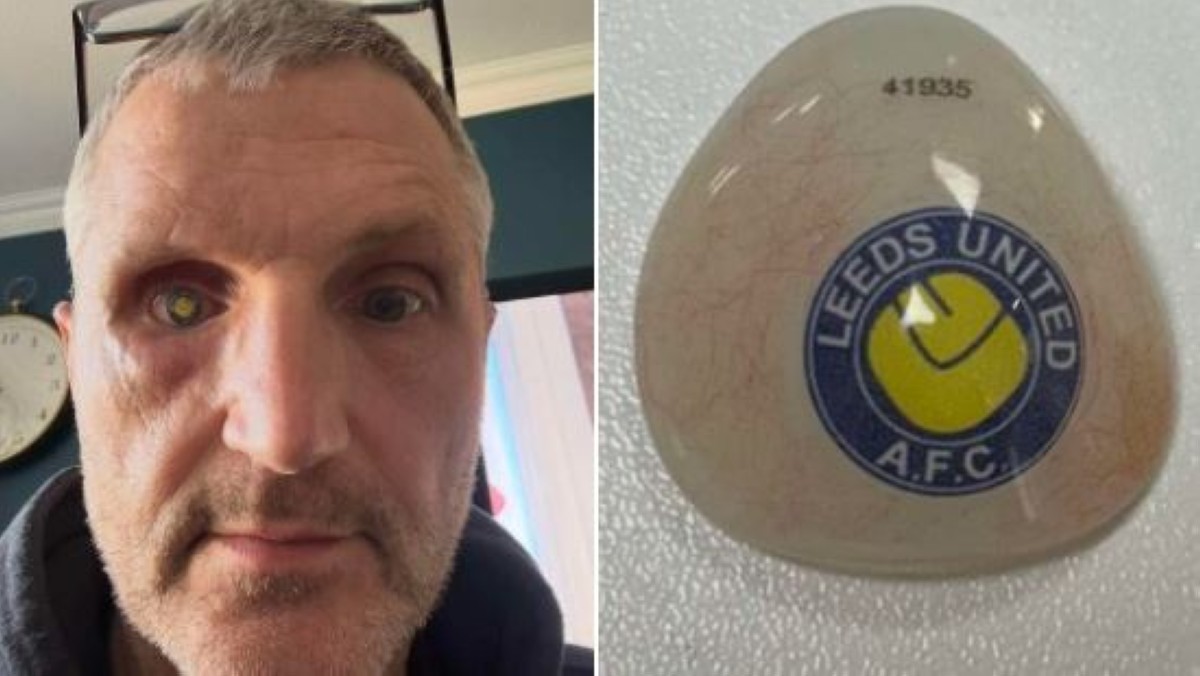 مشجع لنادي ليدز يونايتد يحمل شعار النادي في عينه!