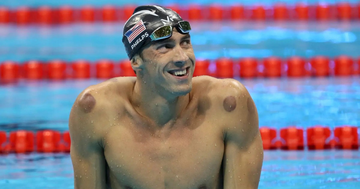 الحصينان: لـ'الحجامة والإبر الصينية' دور مؤثر على أداء الرياضيين