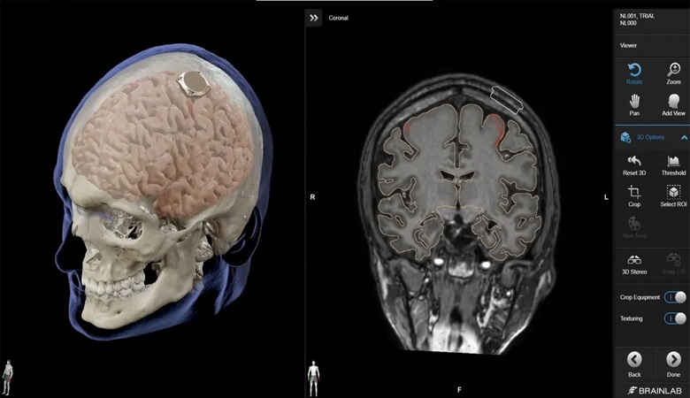 إيلون ماسك يعلن عن نجاح زرع شريحة دماغية في أول إنسان